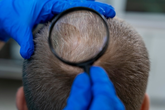 Get a Hair Transplant in Antalya