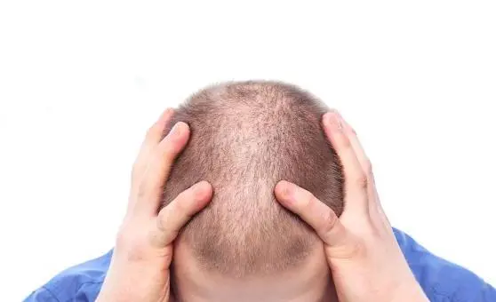 What Is Hair Transplantation?